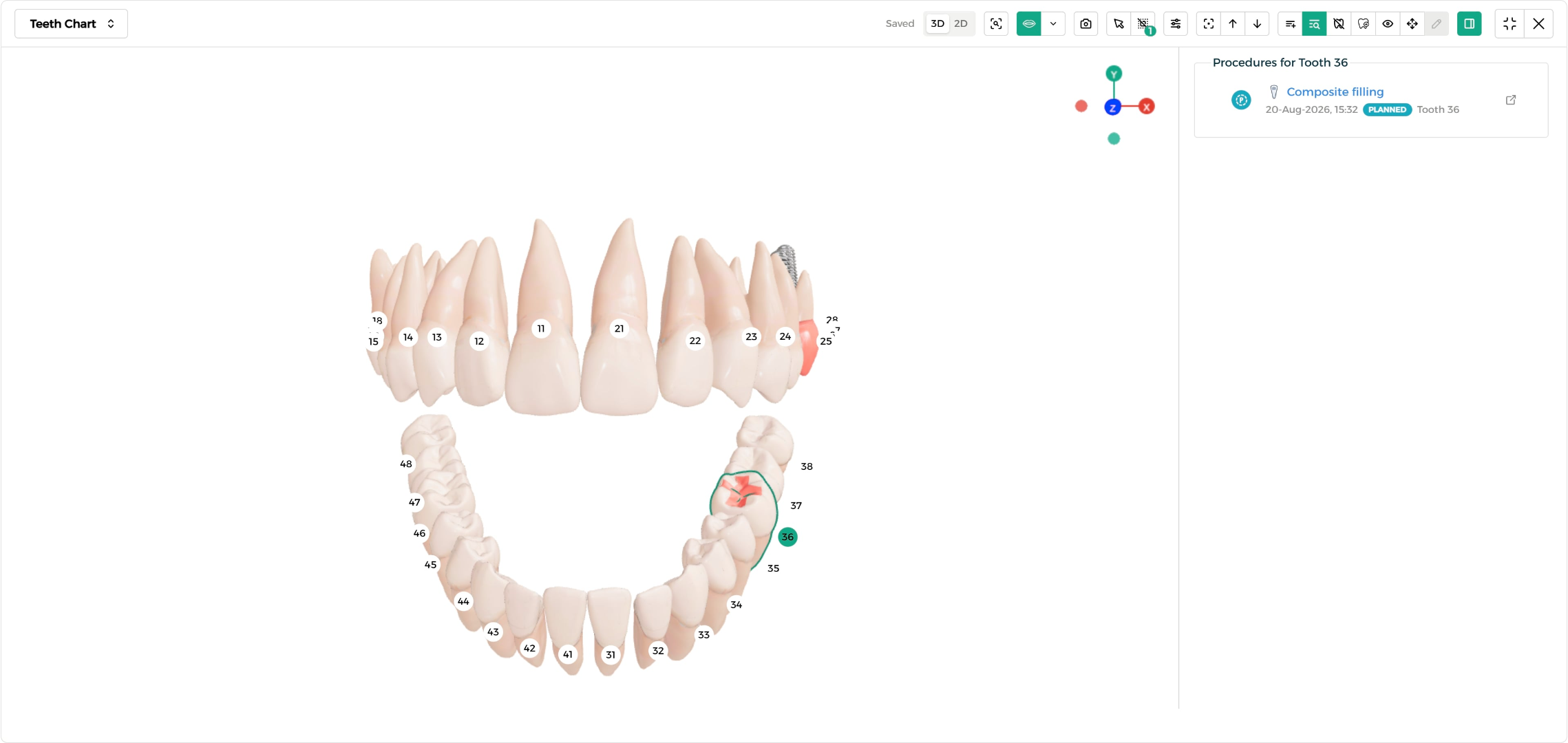 Step 2 - Procedures filtered to one tooth